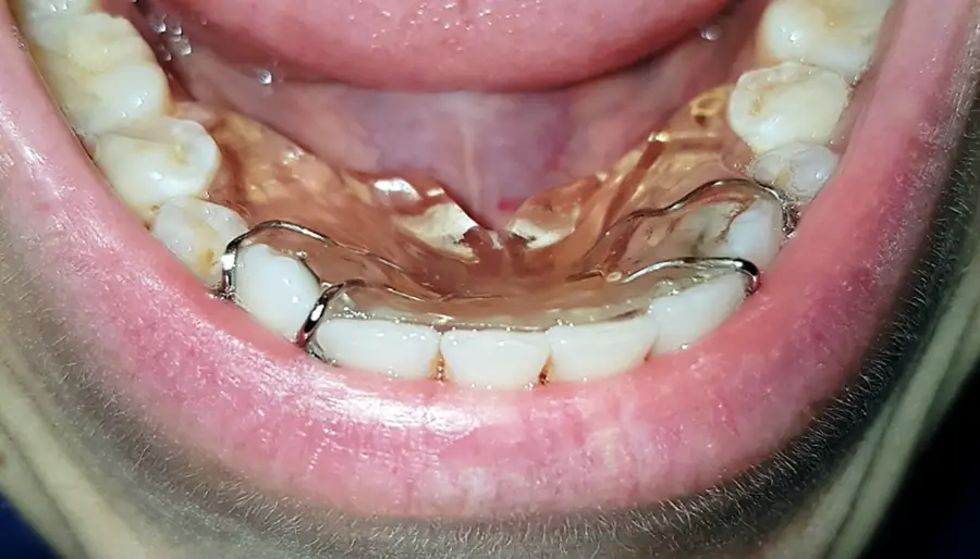 Elevatore linguale Eliba nella cavità orale